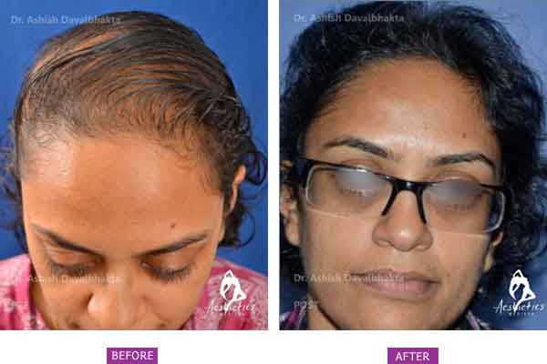 Expert Hair Transplant and Restoration Solutions for Women in India