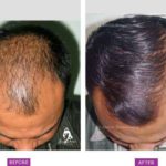 Case 3 : Medical Hair Transplant