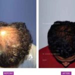 Case 5 : Medical Hair Transplant