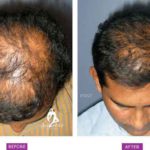 Case 6 : Medical Hair Transplant