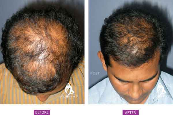 Regain The Fullness Of Your Hair With Hair Transplant In Pune