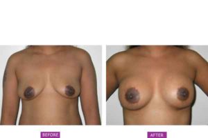 Breast Augmentation