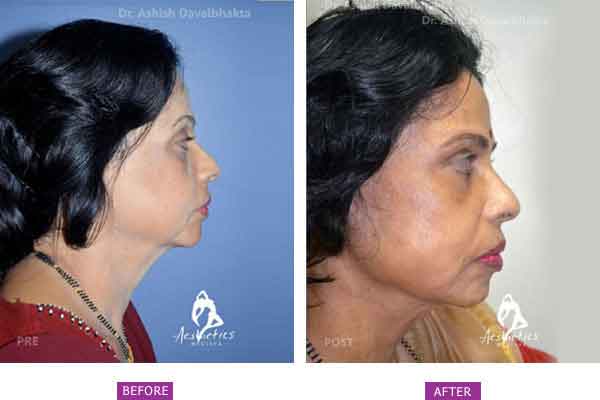 Case 3: (Post Bariatric Ageing) Side View