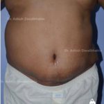 Case 10: Lipoabdominoplasty Surgery