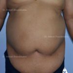 Lipoabdominoplasty Case 10