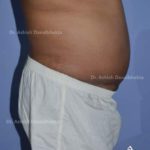 Lipoabdominoplasty Case 10: Side View (After)