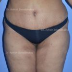 Case 8: Liposuction of Abdomen, Flank, Lower Back, Inner Thigh and Abdominoplasty