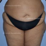 Lipoabdominoplasty Case 8