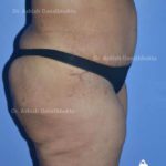 Lipoabdominoplasty Case 8: Side View (After)