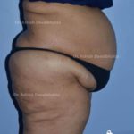 Lipoabdominoplasty Case 8: Side View (Before)