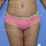 Case 9: Post Vertical C Section Lipoabdominoplasty