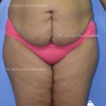 Lipoabdominoplasty Case 9