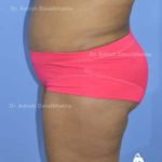 Lipoabdominoplasty Case 9: Side View (After)