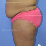 Lipoabdominoplasty Case 9: Side View (Before)