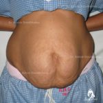 Lipoabdominoplasty Case 1