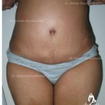 Case 1: Correction of Ventral Hernia with Liposuction and Tummy Tuck