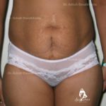 Lipoabdominoplasty Case 4