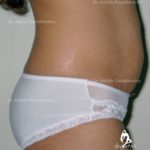 Lipoabdominoplasty Case 4: Side View (Before)