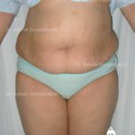 Lipoabdominoplasty Case 5