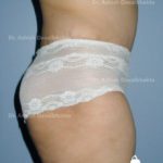 Lipoabdominoplasty Case 5: Side View (After)