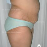 Lipoabdominoplasty Case 5: Side View (Before)