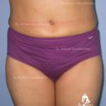 Case 7: Lipoabdominoplasty Surgery