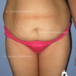 Lipoabdominoplasty Case 7