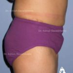 Lipoabdominoplasty Case 7: Side View (After)