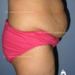 Lipoabdominoplasty Case 7: Side View (Before)