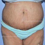 Case 2: Massive Abdominal Panniculus Treated with Liposuction