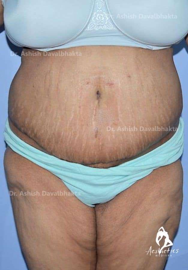 Tummy Tuck Surgery in Kurukshetra, Abdominoplasty in Kurukshetra