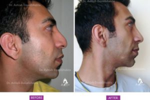 Rhinoplasty Case 12: Tip Projection Improvement