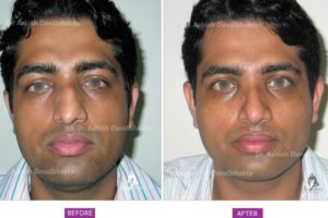 Case 2: Rhinoplasty Case 2: Correction of Deviation and Hump : Front ViewCorrection of Deviation and Hump