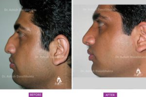 Rhinoplasty Case 2: Correction of Deviation and Hump : Size View