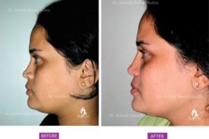 Rhinoplasty Case 5: Augmentation with Alar Flare Correction: Side View