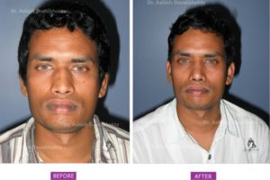 Rhinoplasty Case 6: Narrowing with Hump Reduction and Lip Reduction : Front View