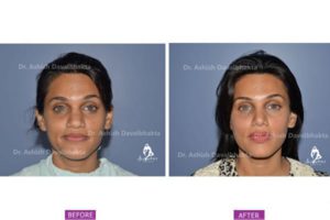 Rhinoplasty Case 7: Augmentation with DCF : Front View