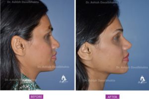 Rhinoplasty Case 7: Augmentation with DCF : Side View