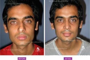 Rhinoplasty Case 8 : Augmentation with Septal Cartilage : Front View