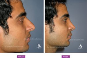 Rhinoplasty Case 8 : Augmentation with Septal Cartilage : Side View