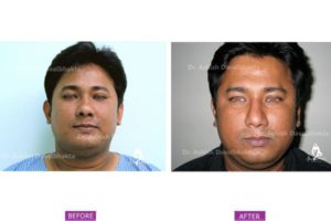 Rhinoplasty Case 9 : Narrowing with Hump Reduction : Front View