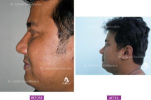 Rhinoplasty Case 9: Narrowing with Hump Reduction : Side View