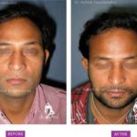 Case 1 : Surgical Hair Transplant : Front View