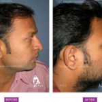 Case 1 : Surgical Hair Transplant : Side View