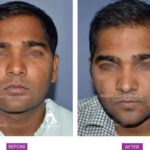 Case 2 : Surgical Hair Transplant : Front View