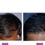 Case 2 : Surgical Hair Transplant : Top View