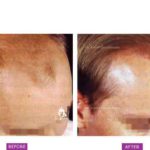 Case 3 (A) : Surgical Hair Transplant