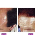 Case 3 (B) : Surgical Hair Transplant