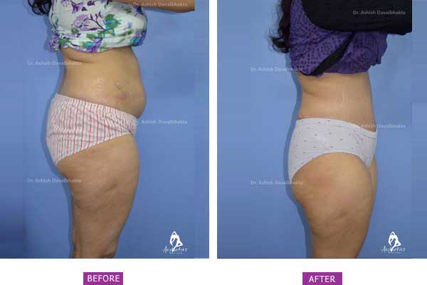 Tummy Tuck elimina grasimile din spate, Pierdere în greutate din guatemala