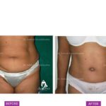 Case 2: Tummy Tuck Surgery